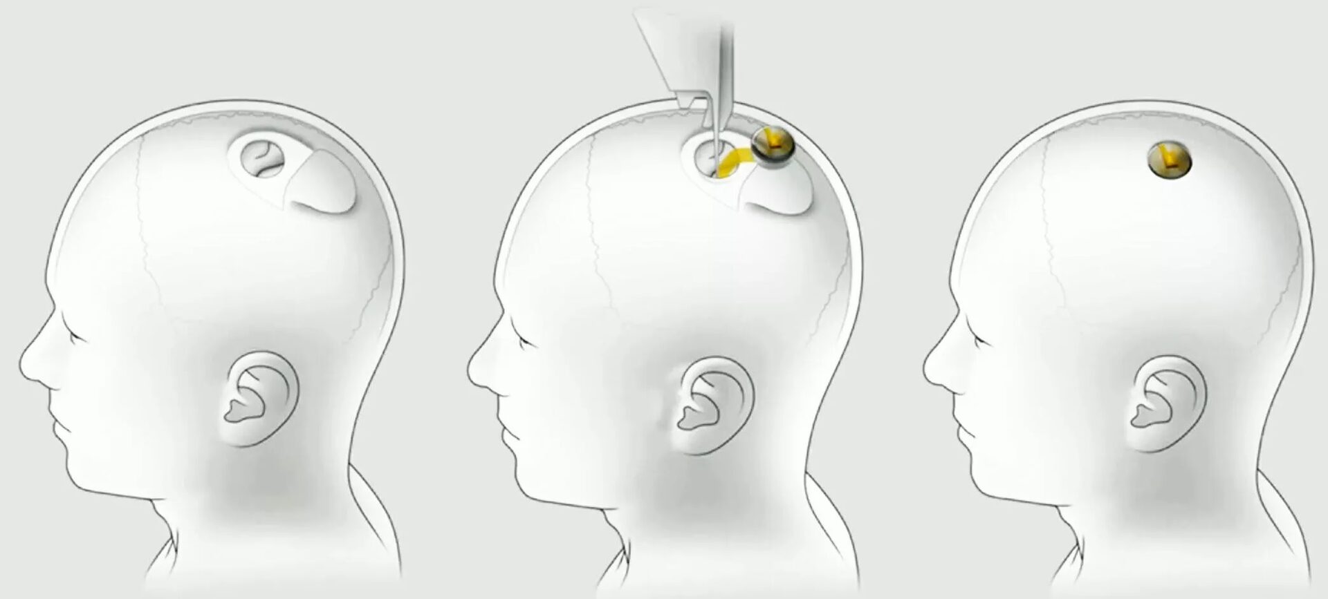 Neuralink-egkefalos-chip