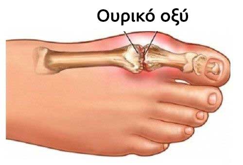 Ο χυμός που διαλύει το ουρικό οξύ στις αρθρώσεις 1 111 2